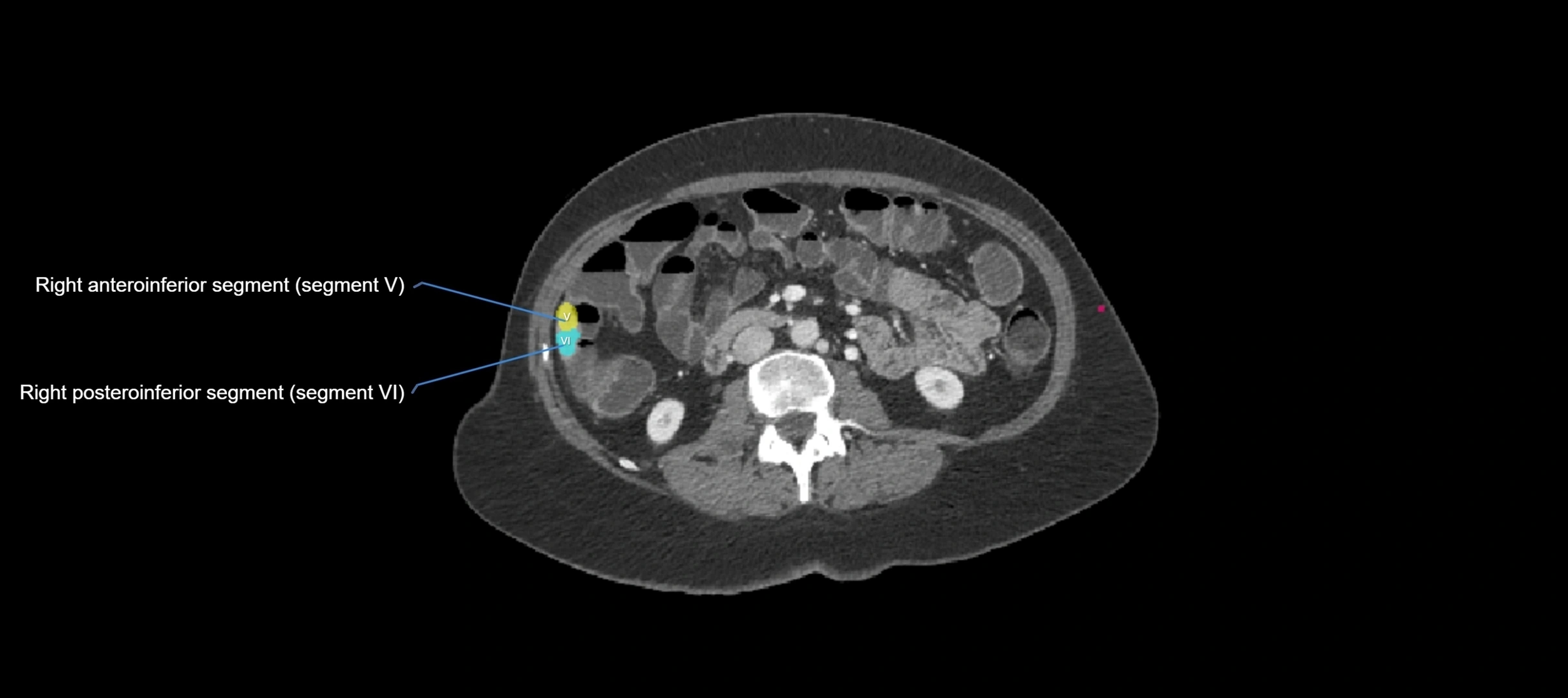 CT liver segments axial cross sectional anatomy labelled image-00003.webp